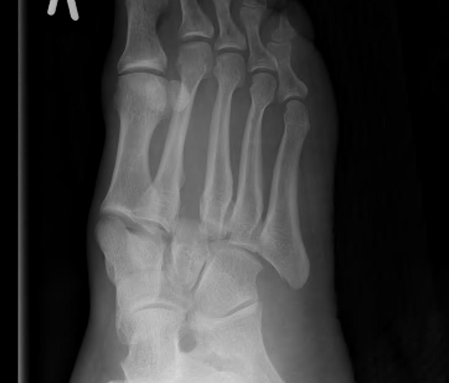 Lis Franc Lateral Column Disruption